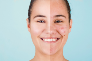 Photo avant et après traitement anti-acné