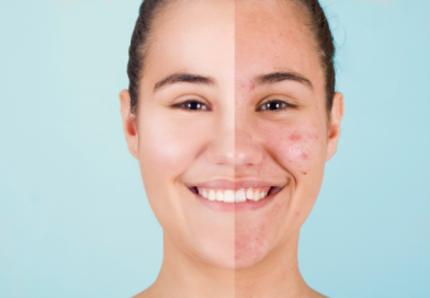 Photo avant et après traitement anti-acné